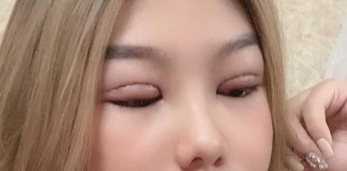 Lựa chọn sai địa chỉ thẩm mỹ là yếu tố đầu tiên khiến trong cắt mí mắt 3 tháng vẫn bị sưng