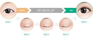 Ưu điểm vượt trội của cắt mí eye lift