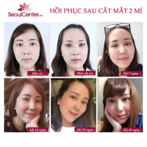 Kết quả cắt mí eye lift tại SeoulCenter.vn