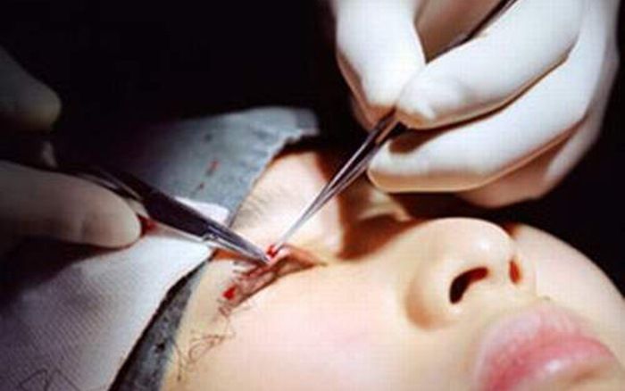 Cắt mí mắt là tiểu phẫu đơn giản