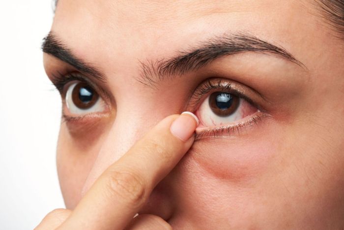 Chế độ ăn uống cũng tác động phần nào đó đến mí mắt sau khi cắt