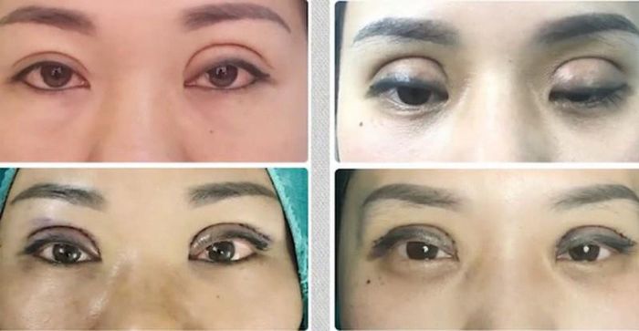 Không tuân thủ chế độ chăm sóc sau khi cắt mí ảnh hưởng nghiêm trọng đến kết quả