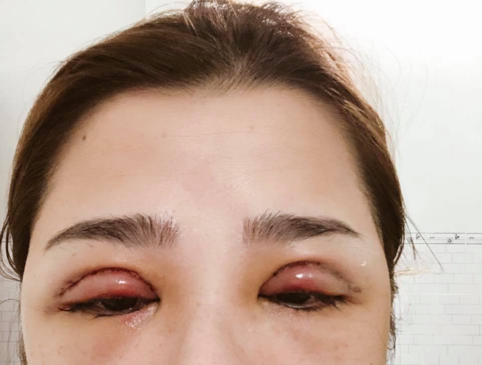 Nguyên nhân mí cắt bị sưng