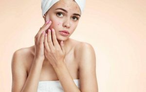 Bạn không nên trị thâm khi da còn mụn