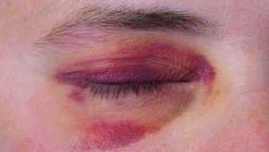 Máu bầm ở mí mắt thường gây sưng đau
