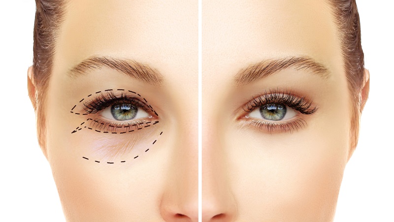 Cắt mí mini deep là một tiểu phẫu đơn giản, nhanh chóng và an toàn