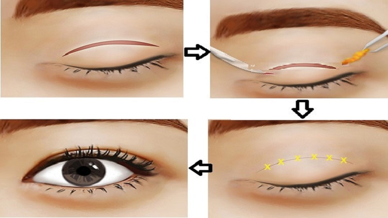 Cắt mí nội soi có rất nhiều ưu điểm nổi bật hơn những kỹ thuật khác