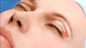 Cắt mí nội soi đảm bảo an toàn, không làm ảnh hưởng đến đôi mắt của bạn