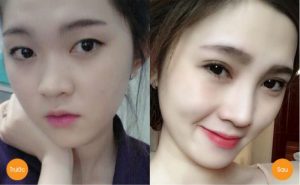 Trả lại vẻ đẹp hoàn hảo cho đôi mắt