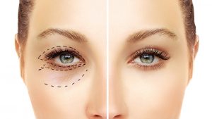 Những trường hợp xấu có thể gặp sau cắt mí mắt