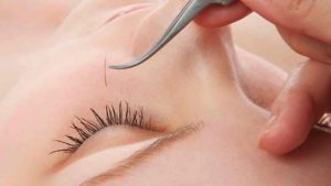 Nguyên nhân nối nhanh rụng