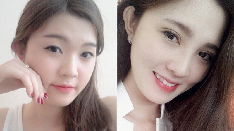Phương pháp nhấn mí vi điểm không cần áp dụng phẫu thuật hay xâm lấn