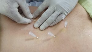 Phương pháp cấy chỉ với các bước tiến hành