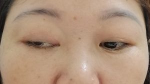 Biểu hiện sụp mí mắt một bên