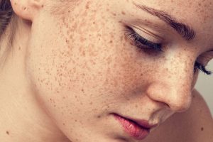 Các vấn đề trên da mặt thường xuất hiện sau khi sinh con.