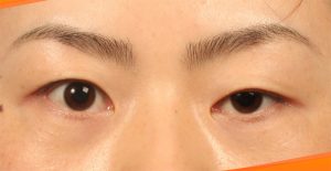 Nhấn mí mắt nếu không đúng kỹ thuật sẽ gây tổn thương nguy hiểm cho mắt