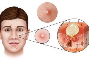 Nguyên nhân gây ra mụn mủ có thể do thói quen sinh hoạt hoặc do cơ địa