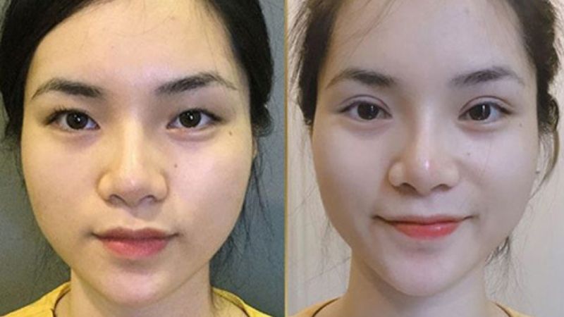 Sau 1 tháng mí mắt bắt đầu dần hồi phục