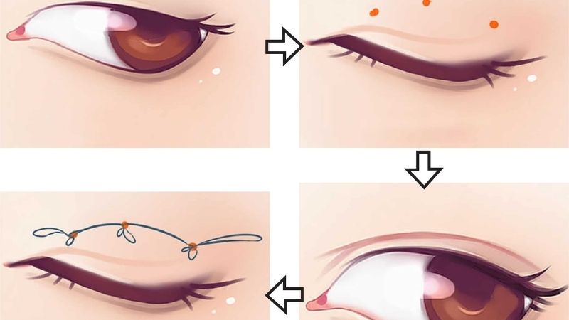 Phương pháp nhấn mí bằng chỉ tự tiêu tiết kiệm được thời gian