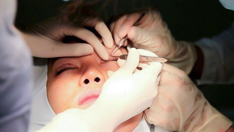 Nhấn mí bằng chỉ tự tiêu an toàn, không xâm lấn