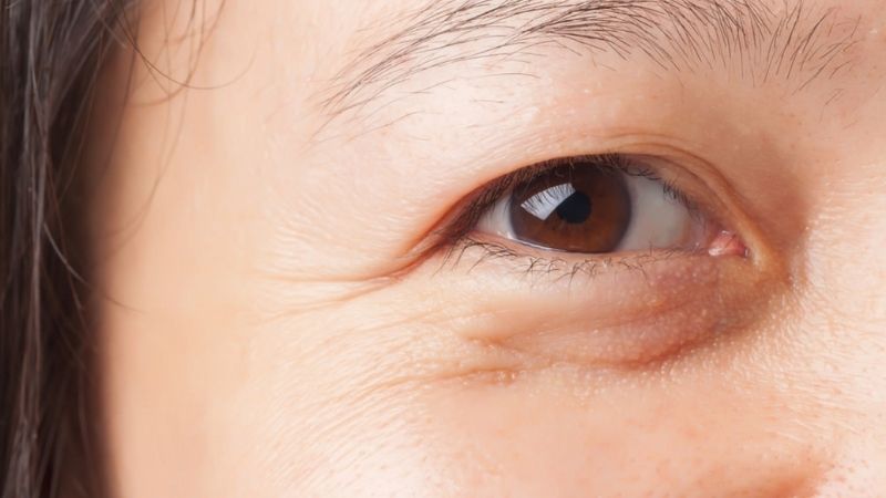 Nhấn mí không phù hợp với người nhiều da dư, mỡ thừa trên mí mắt
