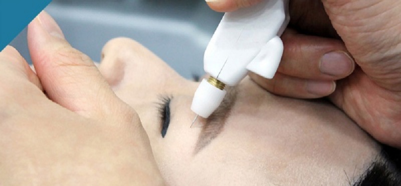 Tia laser tác động lên mí với đường viền vẽ sẵn và đốt cháy phần da thừa để tạo nếp rõ rệt