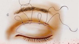 Nhấn mí bằng kỹ thuật hiện đại an toàn, mang tính thẩm mỹ cao