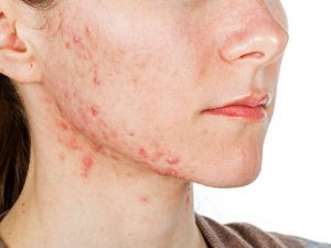 Mụn đỏ hình thành do nhiều nguyên nhân