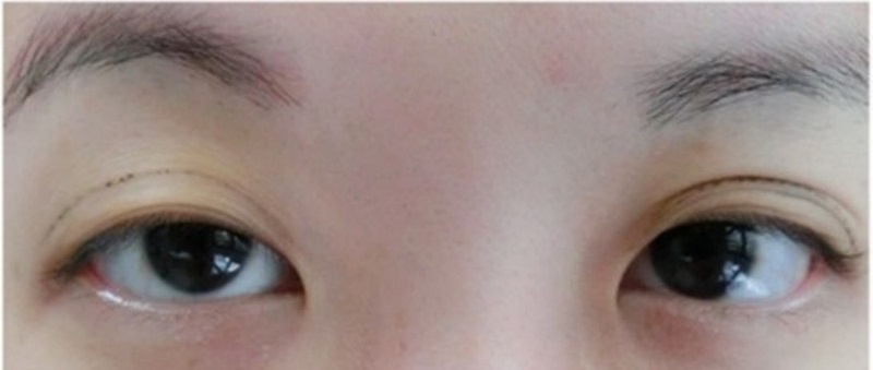 Cắt mí mắt bị lệch là nỗi lo lắng của nhiều người