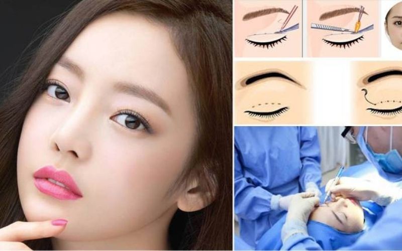 Cắt mí mắt cho người già được thực hiện an toàn, nhẹ nhàng