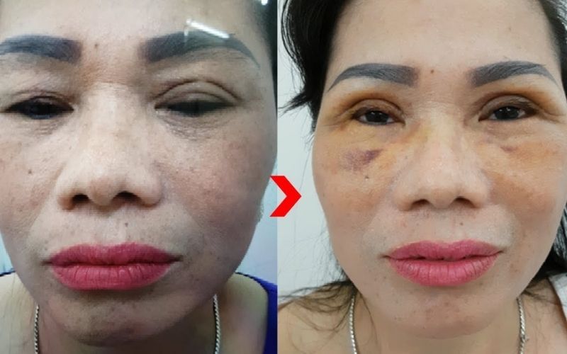 Mắt được trẻ hóa ngay sau khi cắt mí