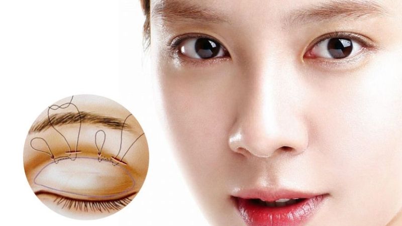 Cắt mí mắt có những tổn thương nhất định, cần ăn chuối để hồi phục nhanh