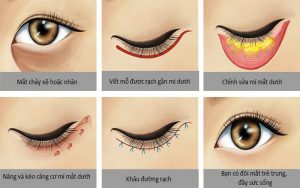 Cắt mí mắt là phương pháp thẩm mỹ tối ưu giúp tạo ra đôi mắt đẹp