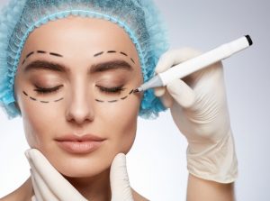 Cắt mí Mini Deep thường mất khoảng 1 tháng để lành lại