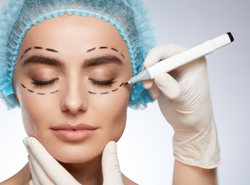 Cắt mí Mini Deep thường mất khoảng 1 tháng để lành lại