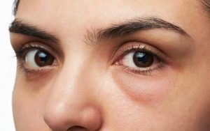 Mí mắt bị sưng sau khi cắt mí là biểu hiện thường thấy