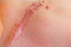 Sẹo lồi gây mất thẩm mỹ