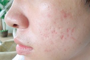 Phương pháp trị sẹo rỗ tự nhiên chỉ thích hợp với loại sẹo rỗ nông và mới hình thành