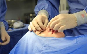 Địa chỉ cắt mí đẹp cần hội tụ nhiều yếu tố khác nhau