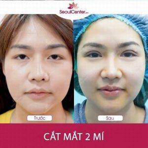 Đôi mắt hai mí lờ đờ và không cân đối của khách hàng đã được thực hiện cắt mí mắt thành công. Sau khi áp dụng công nghệ tại Seoul Center, mắt trở nên cân đối và sắc sảo hơn. Đường nếp mí tự nhiên giúp gương mặt của khách hàng có được sự trẻ trung và duyên dáng hơn so với trước khi thực hiện.