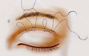 Nhấn mí mắt là một thủ thuật làm mắt 2 mí đơn to tròn, tự nhiên