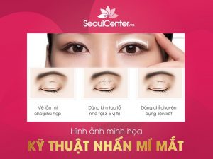 Nhấn mí mắt là phương pháp làm đẹp không phẫu thuật được nhiều người ưa thích