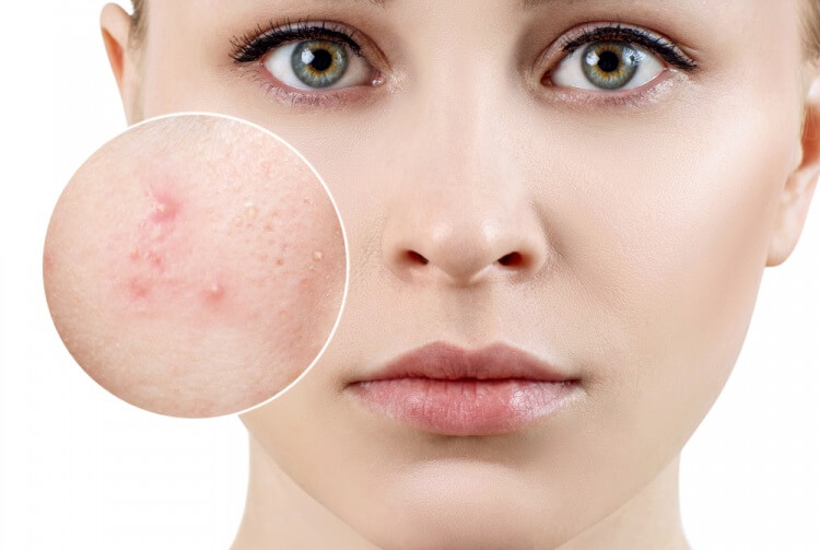 Mụn là một vấn đề rất hay gặp ở thời đại ngày nay.
