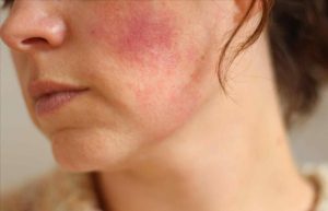Da đỏ hơn sau khi điều trị bằng laser