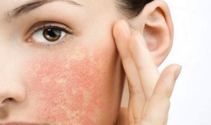 Mẩn đỏ trên da là dấu hiệu rõ rệt nhất khi dị ứng mỹ phẩm