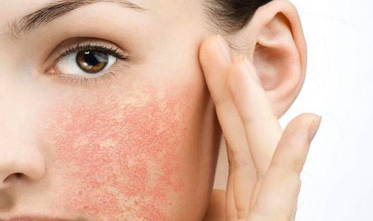 Mẩn đỏ trên da là dấu hiệu rõ rệt nhất khi dị ứng mỹ phẩm