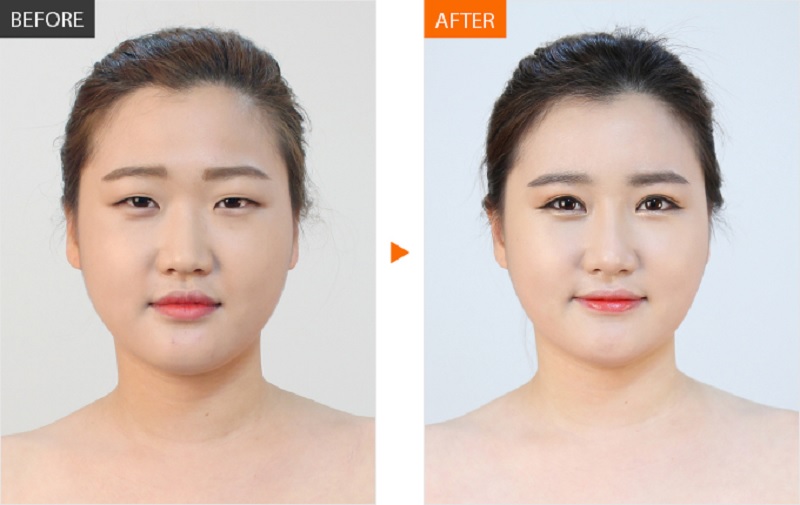 Tại các thẩm mỹ viện lớn, đa phần đều có phương pháp bấm mí độc quyền