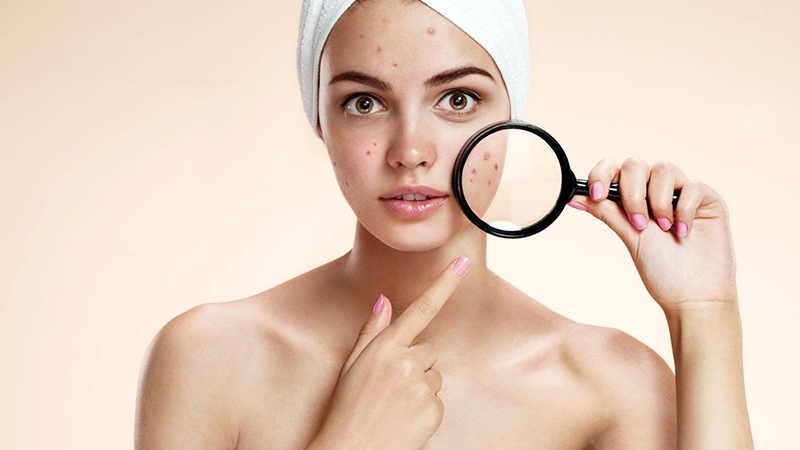 Dầu dừa còn có tác dụng hỗ trợ trị mụn nữa đấy