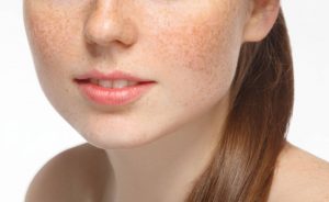 Nám là một loại bệnh lý da do sắc tố melanin tích tụ quá nhiều