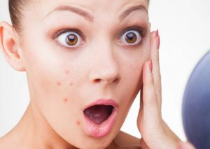                     Mụn khiến bạn mất tự tin và chán nản.
